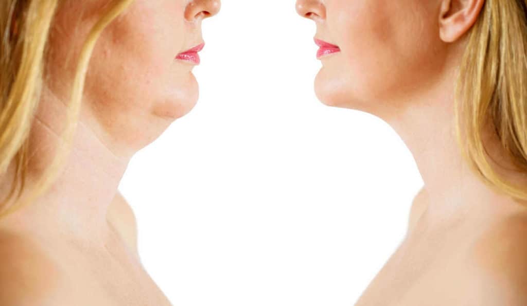 Double Chin treatment Maidenhead before and after results
