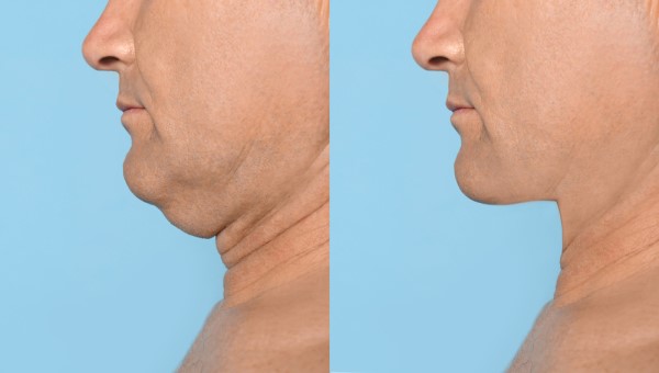 Which Non-Surgical Treatments Work Best for Jowls and Loose Skin Maidenhead?