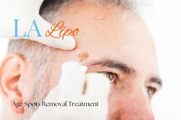 What Are the Most Effective Treatments for Age Spots Maidenhead?