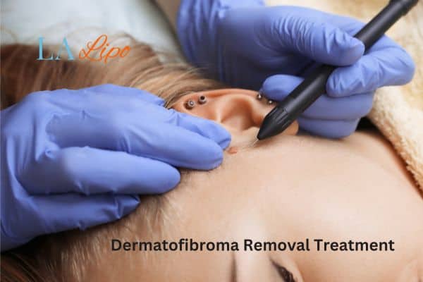 Dermatofibroma Removal Treatment Maidenhead