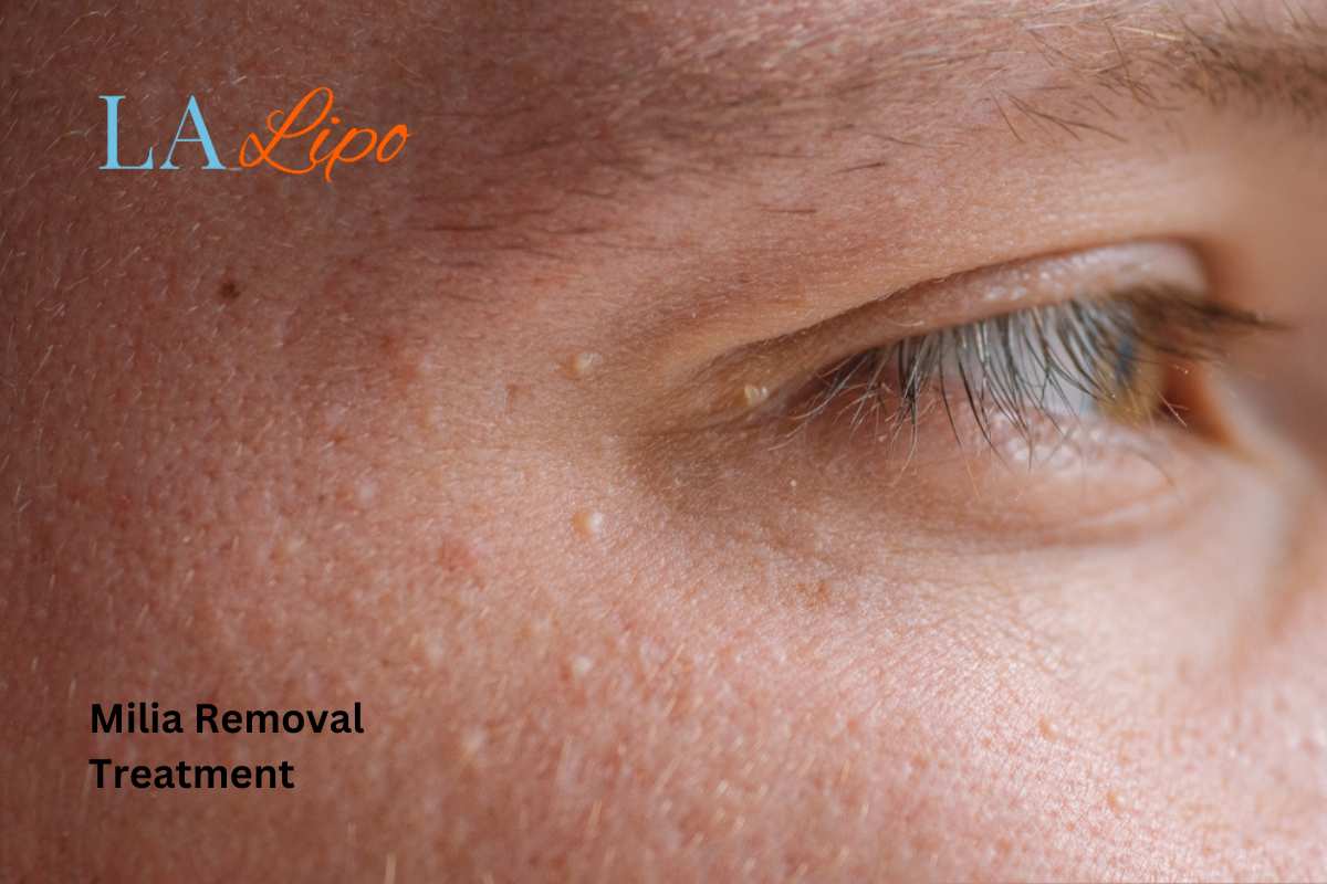 Cryopen Milia Removal: Is It the Easiest and Safest Option Maidenhead?