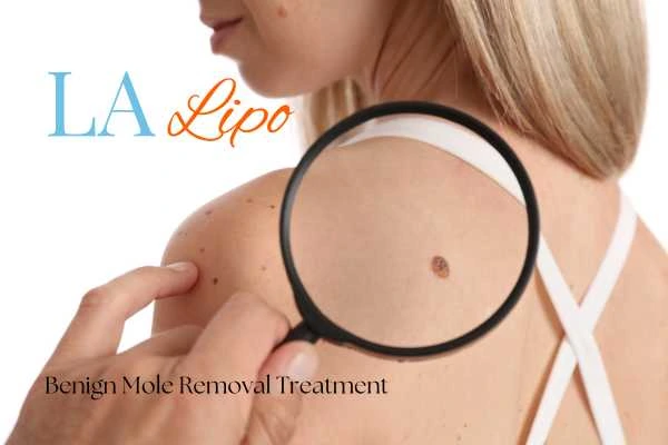 Why getting moles removed Maidenhead can boost your confidence!