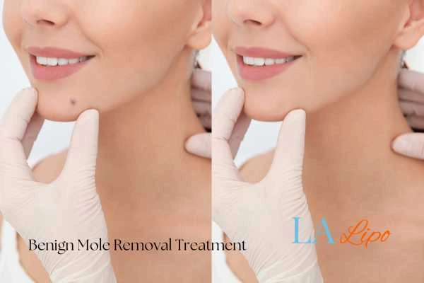 woman's before and after mole removal Maidenhead results