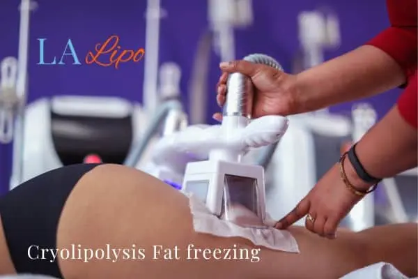 women getting fat freezing Maidenhead