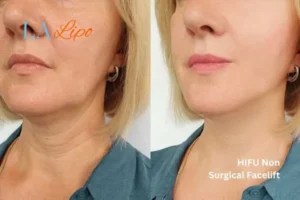 hi-fu for wrinkles Maidenhead before and after results