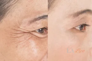 Before and after results of woman - HI-fu wrinkles reduction treatment Maidenhead
