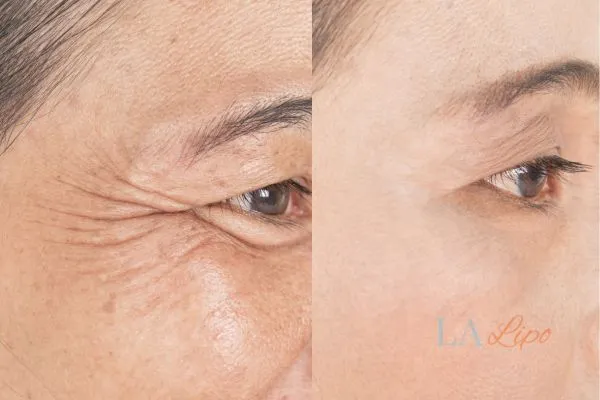 Before and after results of woman - HI-fu wrinkles reduction treatment Maidenhead