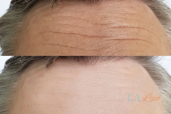 results of HIFU Maidenhead on mans forehead to help reduce lines and wrinkles