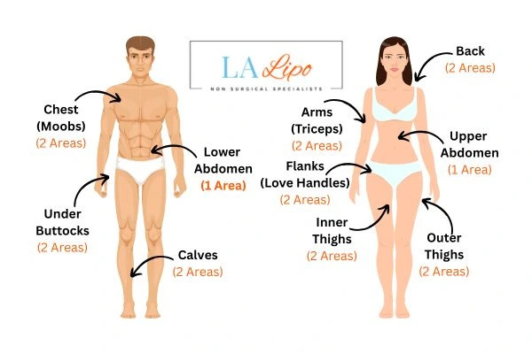 LA LIPO Cryolipolysis Areas Maidenhead