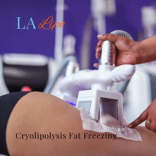 fat freezing - Cryolipolysis Maidenhead