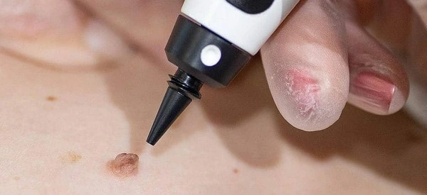 skin tag removal using cryopen Maidenhead