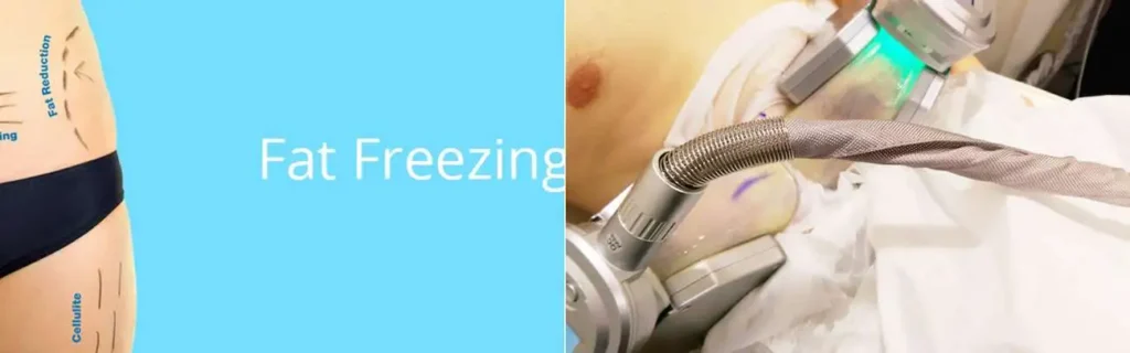 Fat freezing Maidenhead on multiple areas of the body