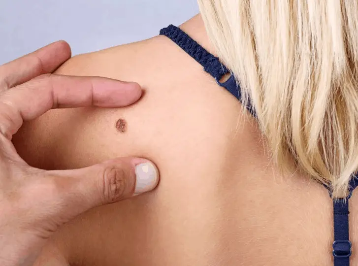 woman having mole removal Maidenhead consultation before treatment.