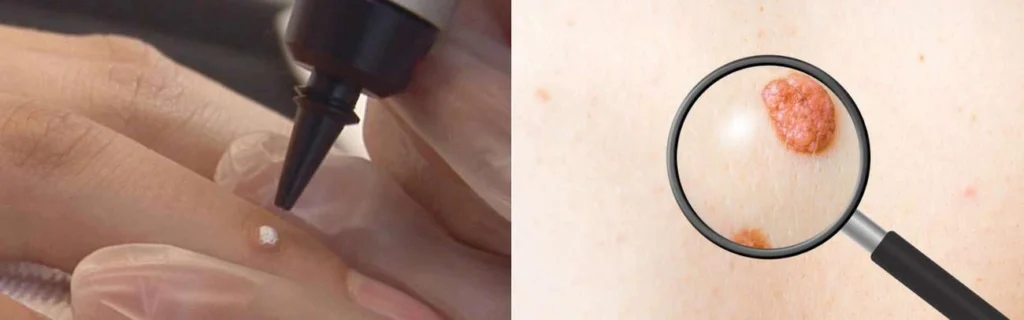 Person getting moles removed with cryopen Maidenhead