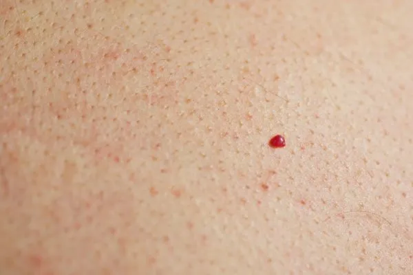 close up of a cherry angioma Maidenhead
