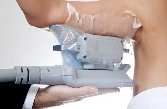 Picture of fat freezing Maidenhead on the upper arms.