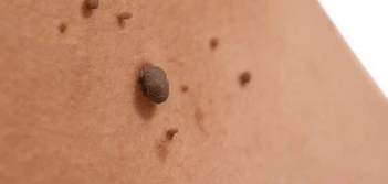 image of a skin tag Maidenhead