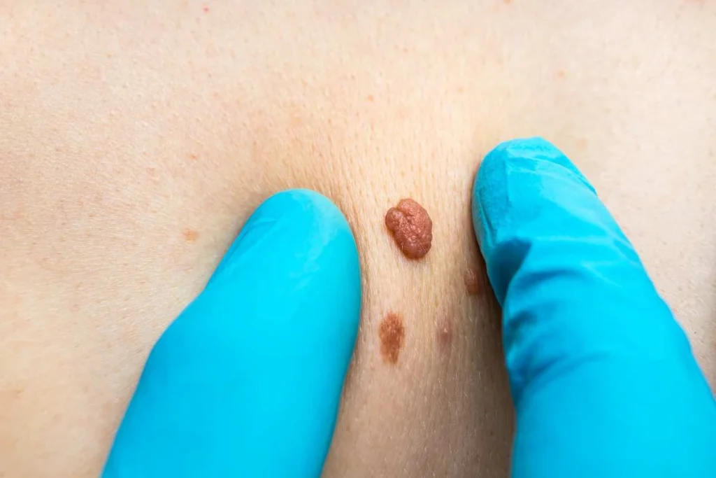 Consultant examining a skin tag Maidenhead