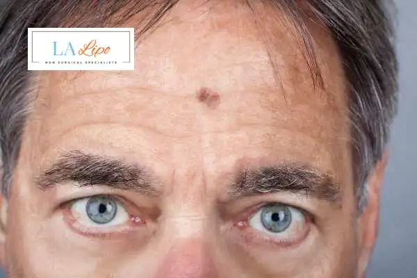 Solar Lentigo Removal Maidenhead image of man with mark on his forehead