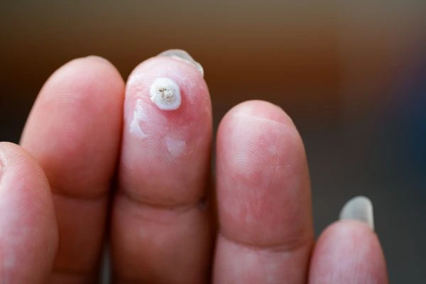 wart on person finger - cryotherapy to treat from LA LIPO Maidenhead