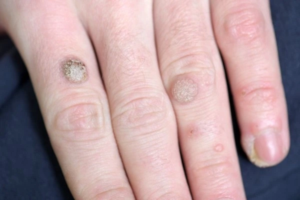 photo of warts on person hand - see wart removal Maidenhead from LA LIPO