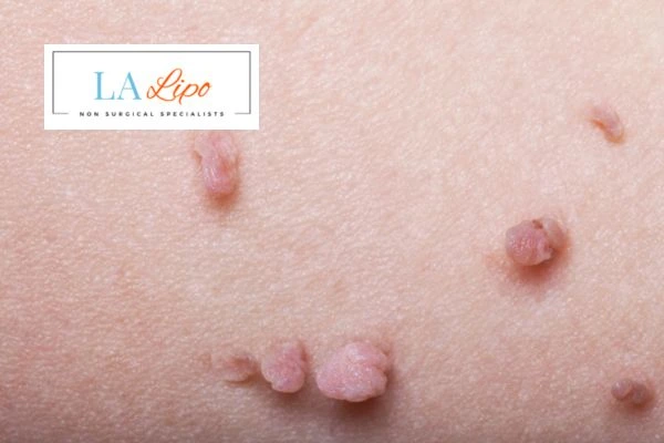 Does cryopen skin tag removal Maidenhead hurt? Find out now call our team today!