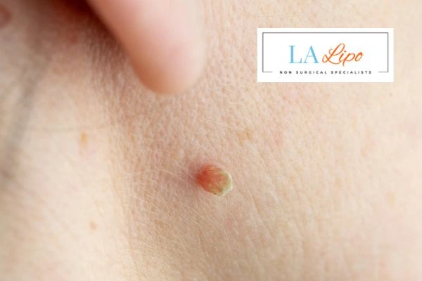 Book skin tag removal Maidenhead today speak to our team now!