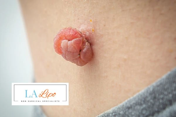 Interested in skin tag removal Maidenhead? Concerned about the pain? Find out more today!