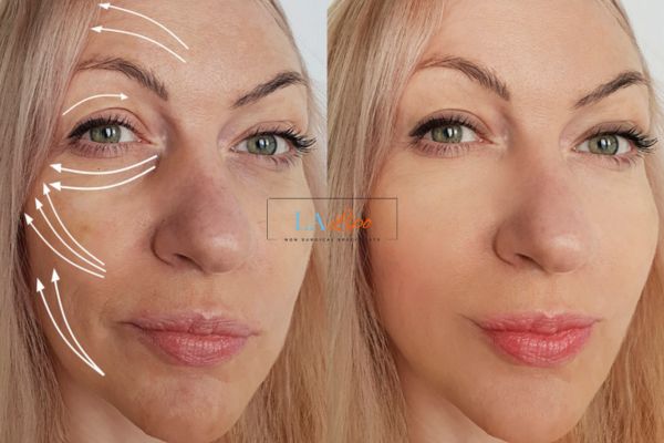 Morpheus 8 results Maidenhead face lift.
