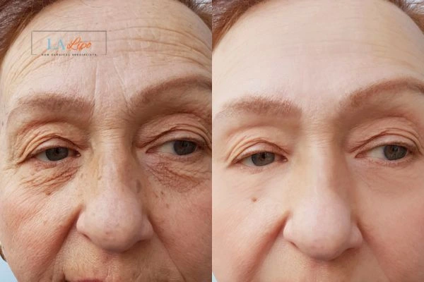 The powerful benefits of Morpheus8 Treatment Maidenhead - Call Our team today!