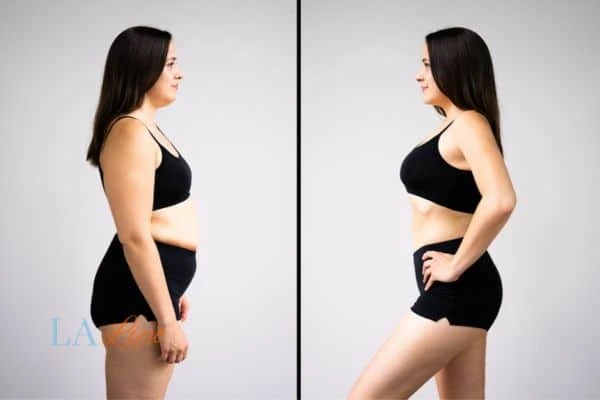 Picture of womans before and after using LA-EMS body sculpting to improve her core strength Maidenhead
