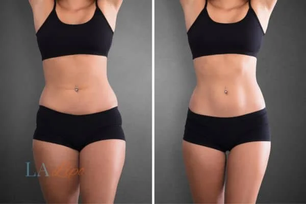 before and after results of non-surgical treatment to help a woman's body image and mental health Maidenhead