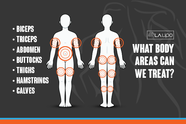 Diagram to show areas you can have LA-EMS Body Sculpting Treatment Maidenhead