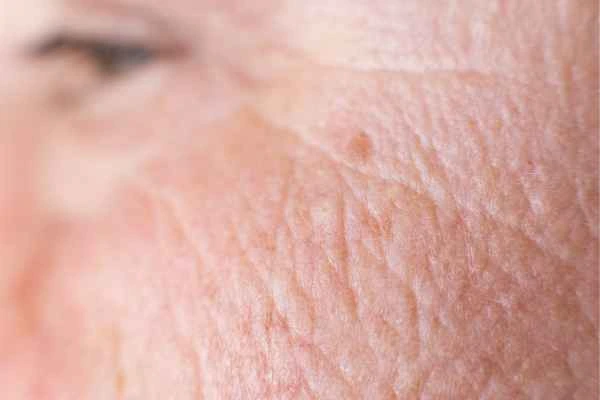 close up picture of a woman's face showing an age spot Maidenhead