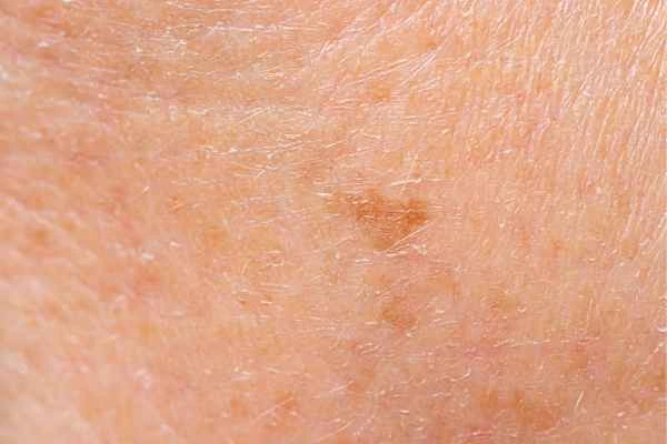 close up picture of age spots Maidenhead