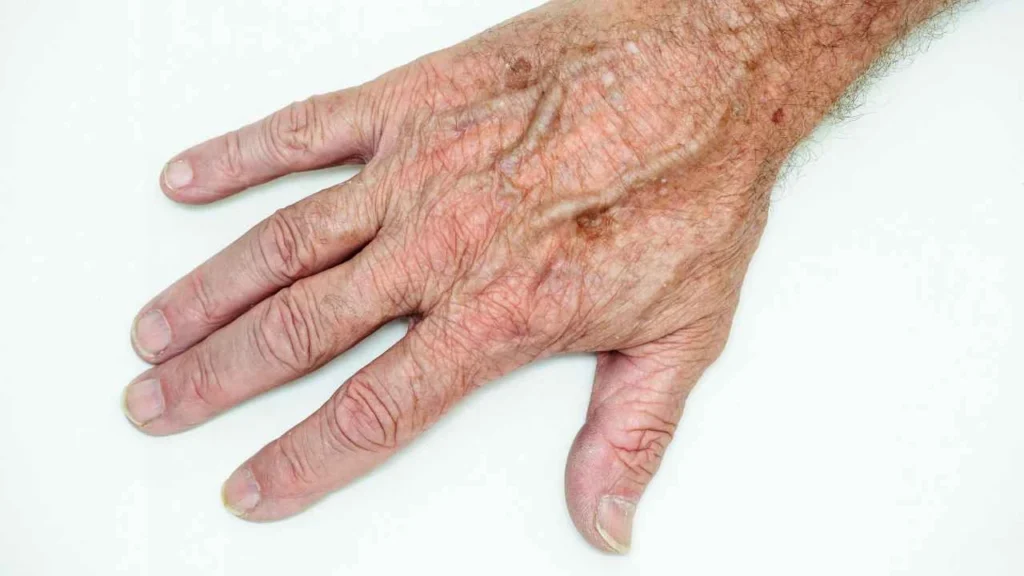 Male hand showing age spot Maidenhead