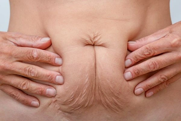 Image of a woman's stomach with loose skin - example of skin tightening Maidenhead options