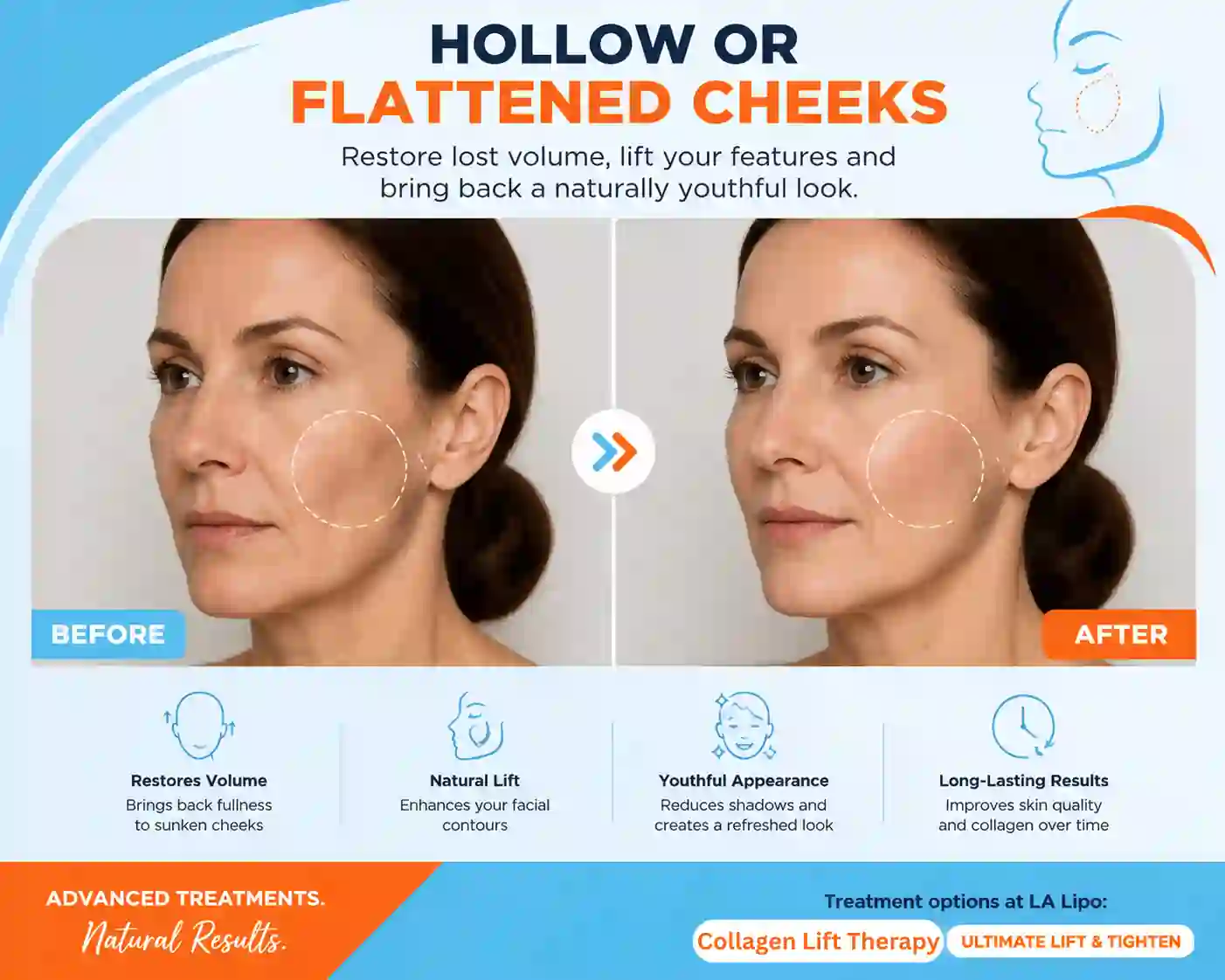 Sign #4: Hollow or Flattened Cheeks Maidenhead