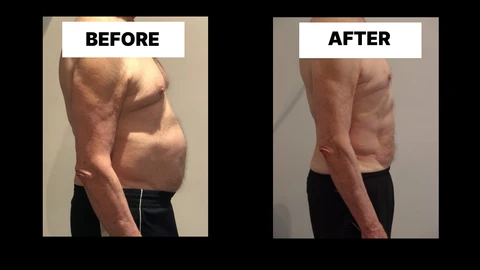 What Symptoms Can Diastasis Recti Cause in Men? Weak Core, Back Pain and Poor Posture Maidenhead